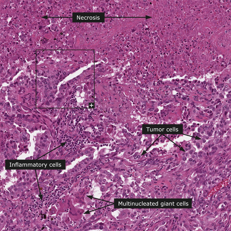 Dictionary Cancer Lung Cancer The Human Protein Atlas