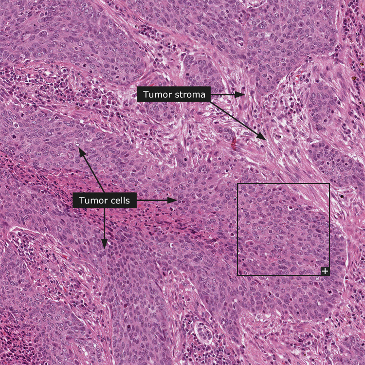Squamous Cell Carcinoma Lung Histology