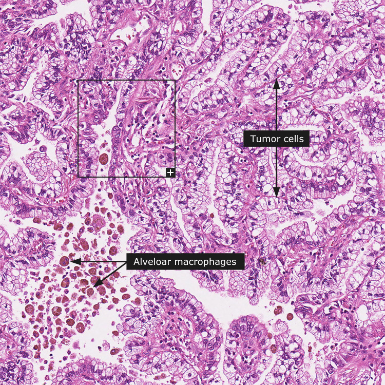 lung cancer histology