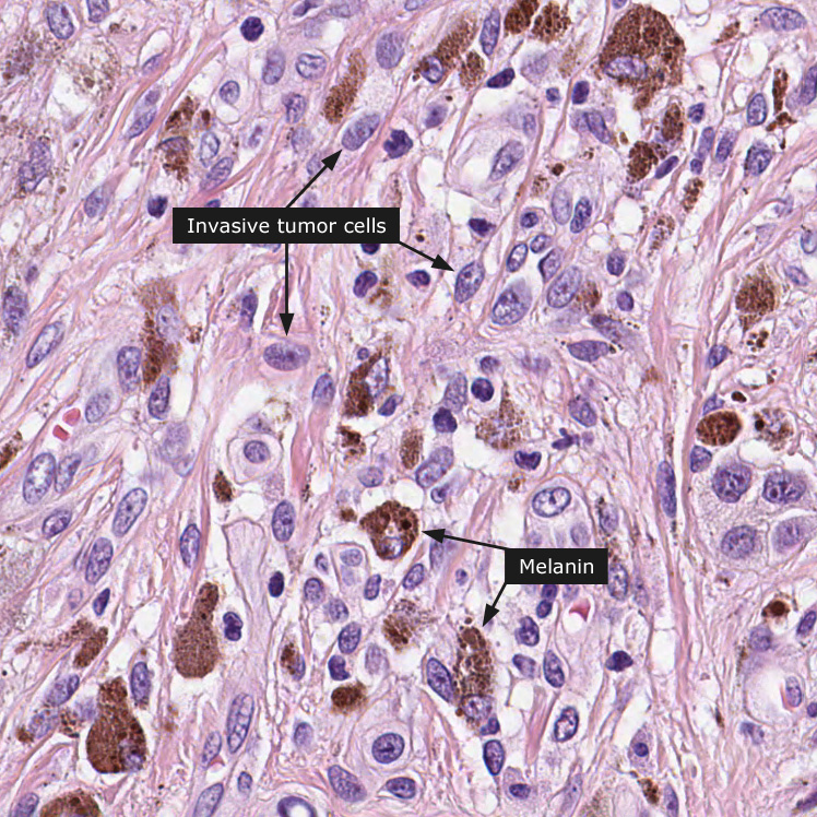 Мрт меланомы. Нодулярная меланома гистология. Акральная лентигинозная меланома: патанатомия.