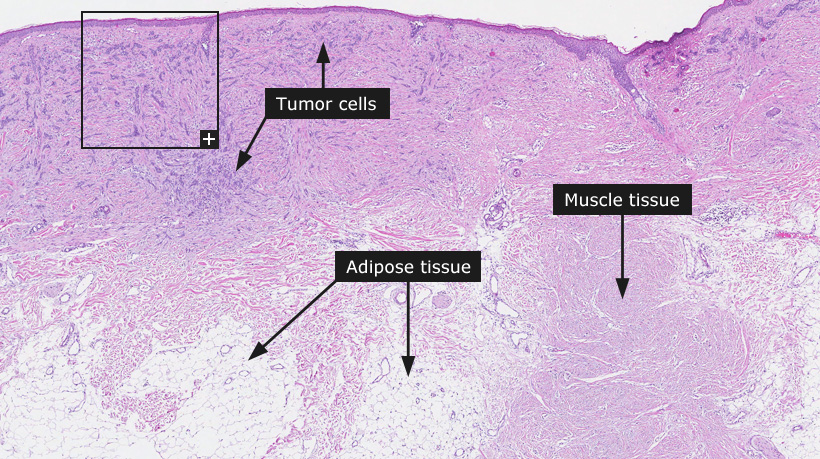 basal cell carcinoma vs squamous cell carcinoma histology